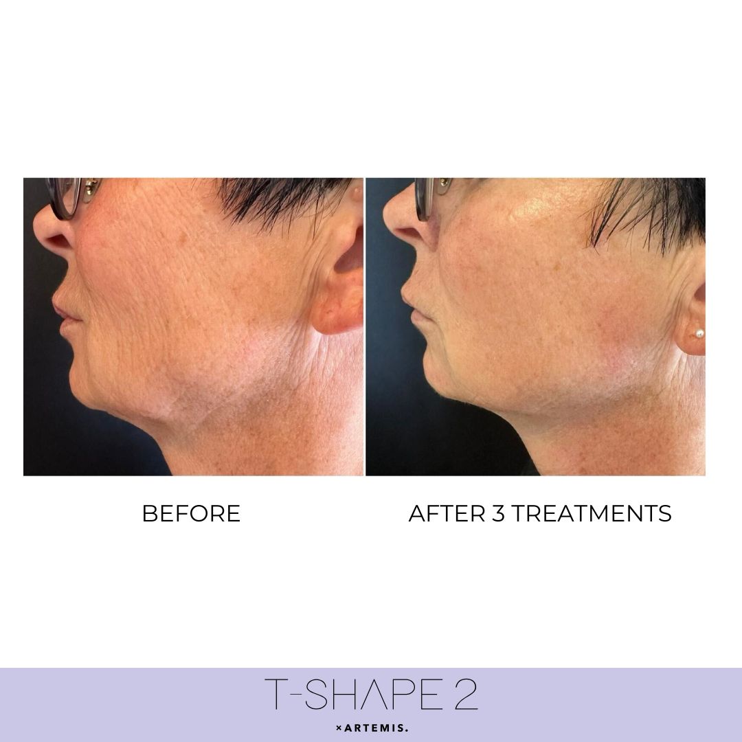 T-Shape 2 result — Neck, After 3 treatments