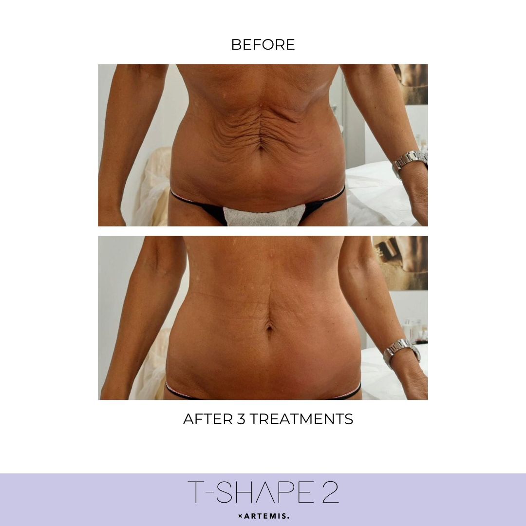 T-Shape 2 result — Abdomen, After 3 treatments