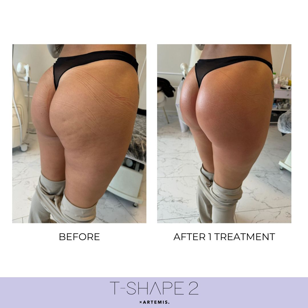 T-Shape 2 result — Body, After 1 treatment