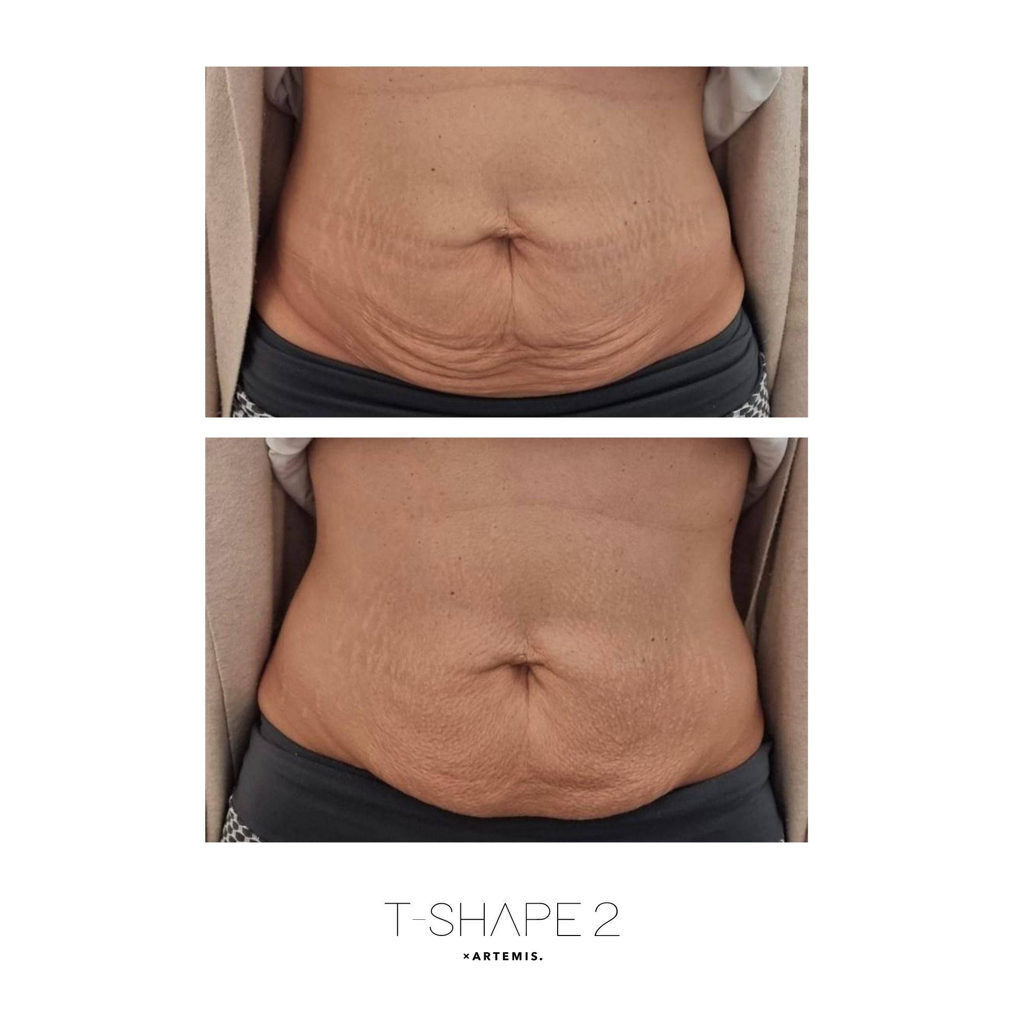 T-Shape 2 result — Abs, After treatment series