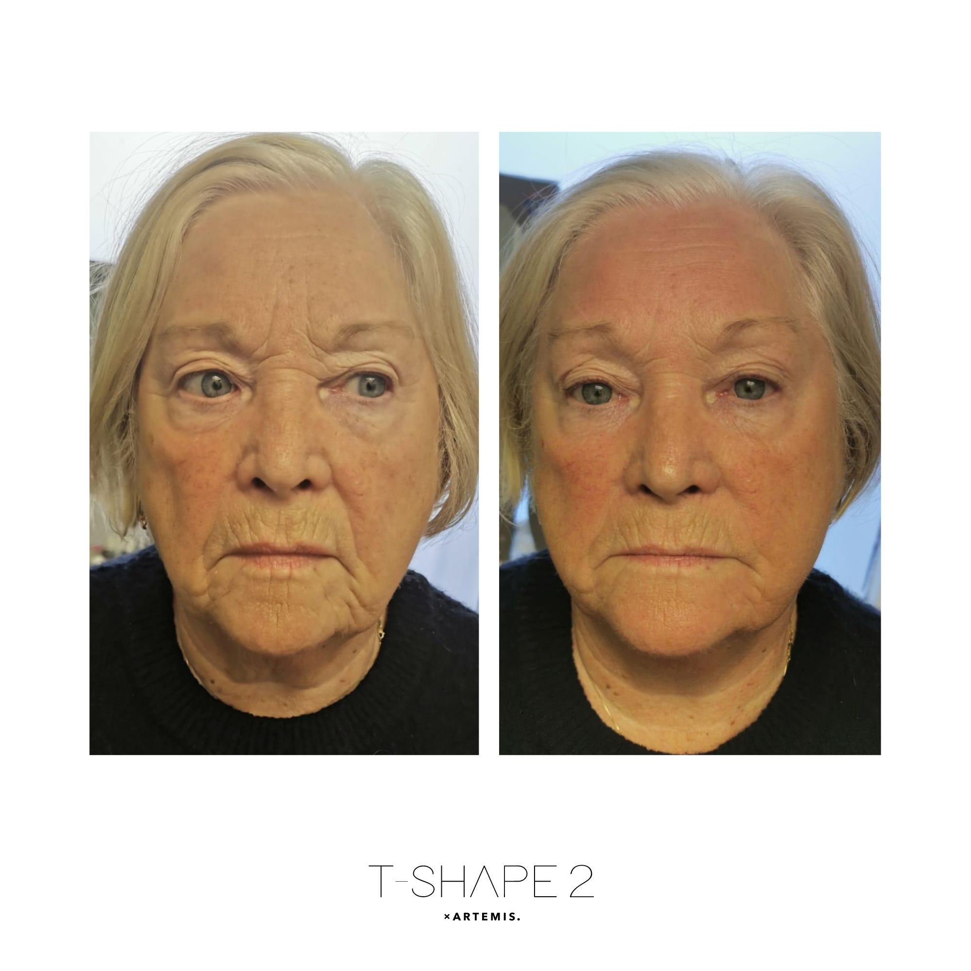 T-Shape 2 result — Face, After 1 treatment