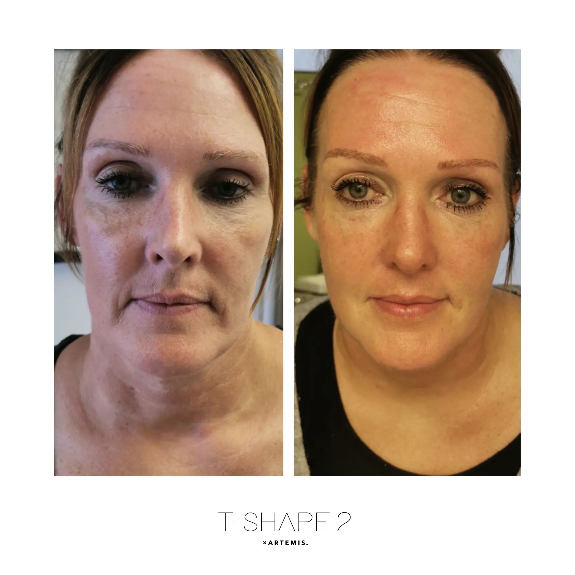 T-Shape 2 result — Face, After 4 treatments